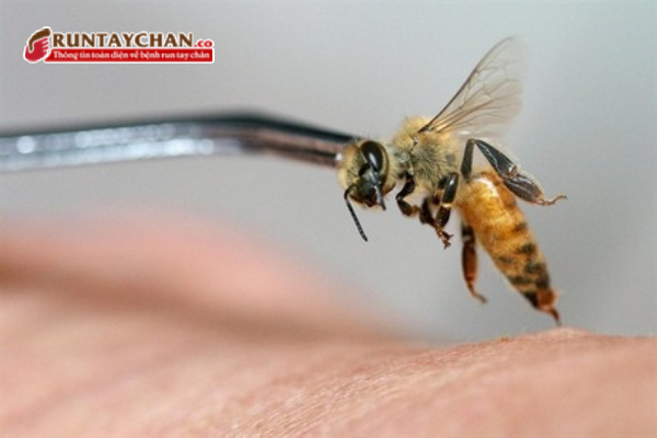 Nọc ong dùng để châm cứu điều trị bệnh Parkinson